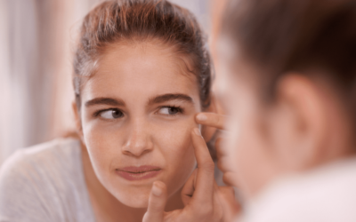How To Care For Blemish Prone Skin